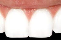 cosmetic bonding after