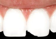 cosmetic bonding before