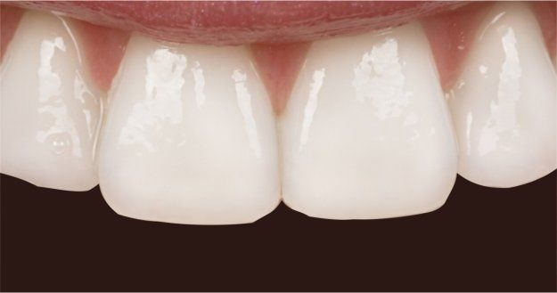 porcelain veneers after