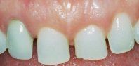 porcelain veneers before