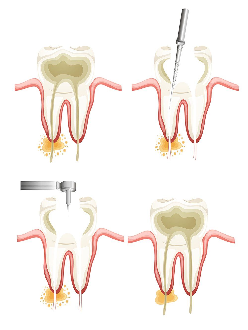 endodontics / root canal treatments