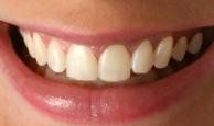 Teeth whitening before
