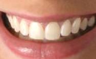 Teeth whitening after